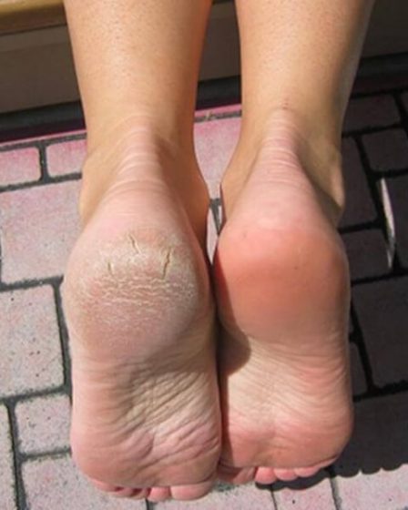 Các biểu hiện của nứt gót chân